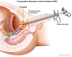 prostate-03-turp-trans-urithral-resection-of-prostate
